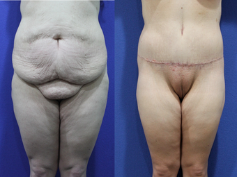 Body Lift before 1388948