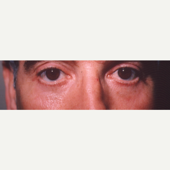 45-54 year old man treated with Eye Bags Treatment after 3545002