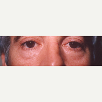 45-54 year old man treated with Eye Bags Treatment before 3545002