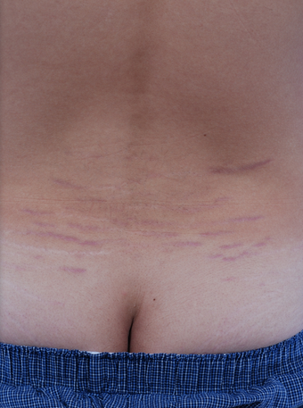 Stretch Mark Removal before 471894