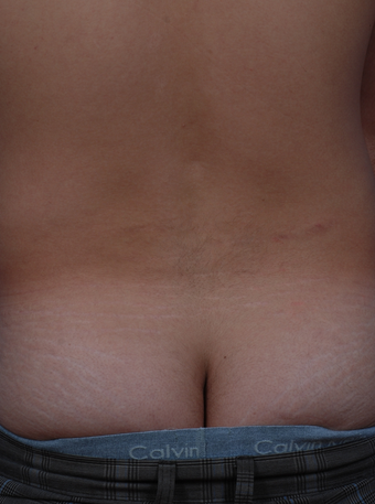 Stretch Mark Removal after 471894