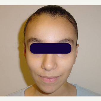 18-24 year old female treated with Otoplasty or Ear Pinning after 3570293