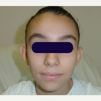 18-24 year old female treated with Otoplasty or Ear Pinning before 3570293