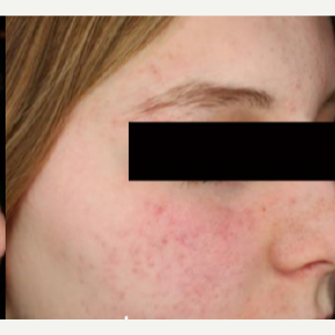 25-34 year old woman treated with Acne Scars Treatment after 3011097