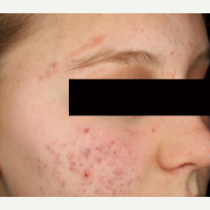 25-34 year old woman treated with Acne Scars Treatment before 3011097