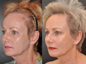 65 year old female facial skin firming with Sculptra before 1427606