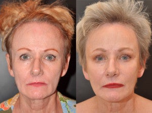 65 year old female facial skin firming with Sculptra after 1427606