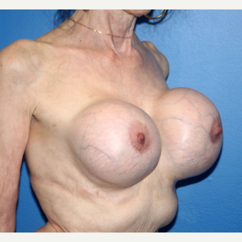 65-74 year old woman treated with Breast Implant Revision before 3366548