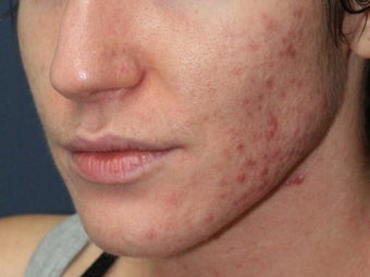 Before & After Photodynamic Therapy 931522