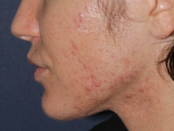 Before & After Photodynamic Therapy after 931522