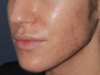 Before & After Photodynamic Therapy 931522