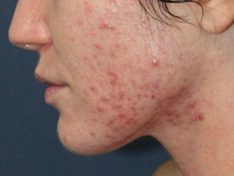 Before & After Photodynamic Therapy before 931522
