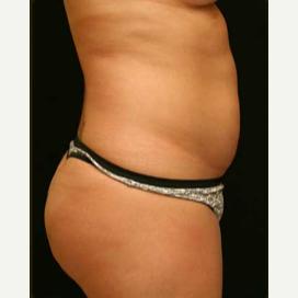 Liposuction of the abdomen and flanks before 3122699