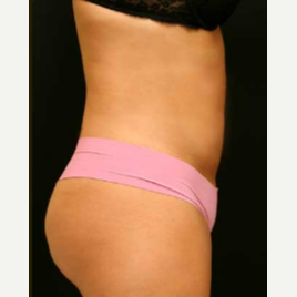 Liposuction of the abdomen and flanks after 3122699
