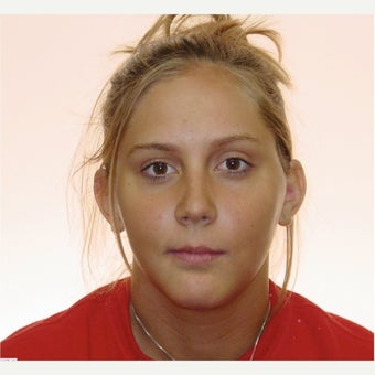 Anterior Openbite With Recessed Mandible (Lower Jaw) Treated With Orthognathic Surgery after 1948229