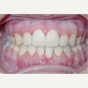 Anterior Openbite With Recessed Mandible (Lower Jaw) Treated With Orthognathic Surgery 1948229