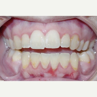 Anterior Openbite With Recessed Mandible (Lower Jaw) Treated With Orthognathic Surgery 1948229