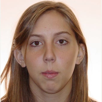 Anterior Openbite With Recessed Mandible (Lower Jaw) Treated With Orthognathic Surgery before 1948229