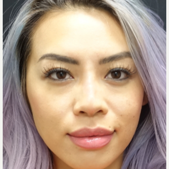 25-34 year old woman treated with Filler for her Rhinoplasty after 3152202