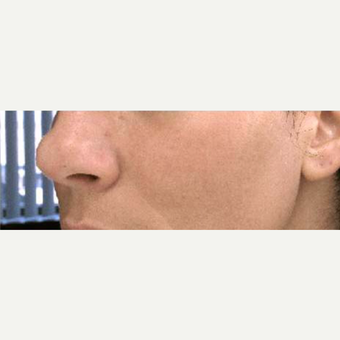 35-44 year old woman treated with Chemical Peel after 3713497
