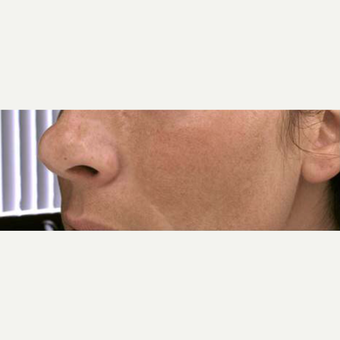35-44 year old woman treated with Chemical Peel before 3713497