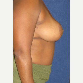 35-44 year old woman treated with Breast Reduction 1556081