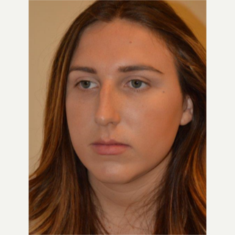 18-24 year old woman treated with Rhinoplasty before 3657957