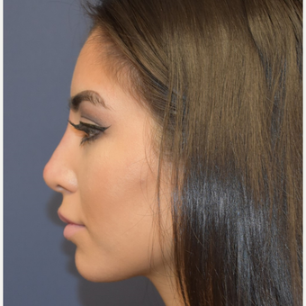 18-24 year old woman treated with Non Surgical Nose Job after 3854704