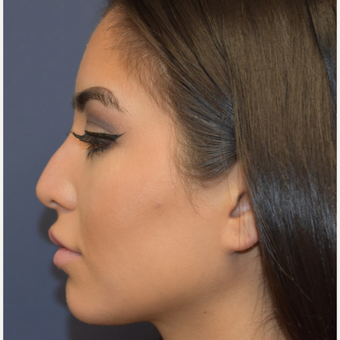 18-24 year old woman treated with Non Surgical Nose Job before 3854704