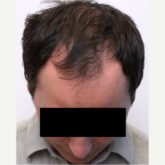 35-44 year old man treated with Organic Hair Transplant before 3172506