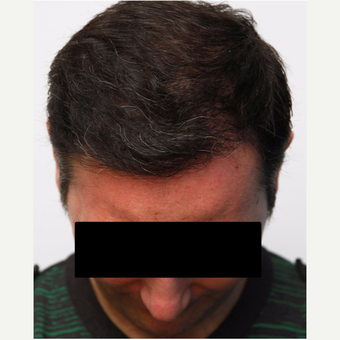 35-44 year old man treated with Organic Hair Transplant after 3172506