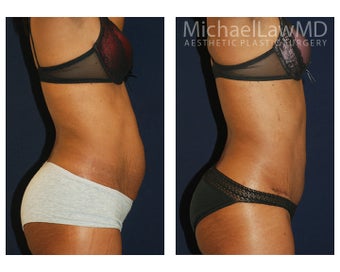 Abdominoplasty before 1293784