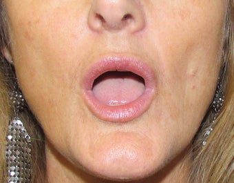 Lip Augmentation | Lip Implant for this 53 Year Old Female 1432139