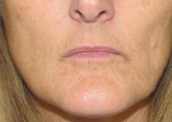 Lip Augmentation | Lip Implant for this 53 Year Old Female before 1432139
