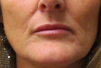 Lip Augmentation | Lip Implant for this 53 Year Old Female after 1432139
