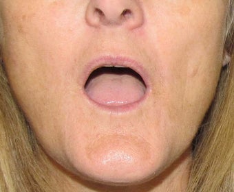 Lip Augmentation | Lip Implant for this 53 Year Old Female 1432139
