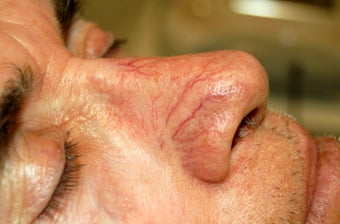 VeinGogh for Removal of Spider Veins on Nose before 1166002