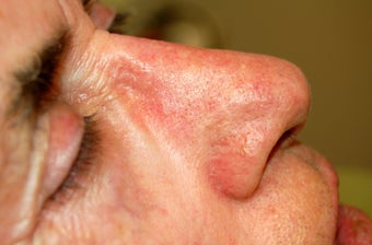 VeinGogh for Removal of Spider Veins on Nose after 1166002