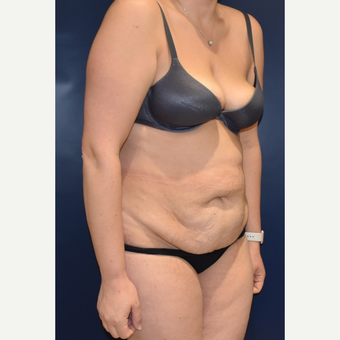 35-44 year old woman treated with Tummy Tuck before 3489822