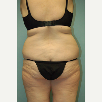 58 year old woman, 5'6", 188 lbs. four months after lipoabdominoplasty before 3771654