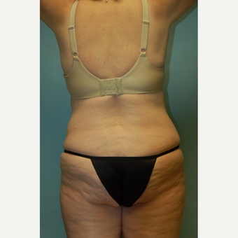 58 year old woman, 5'6", 188 lbs. four months after lipoabdominoplasty after 3771654