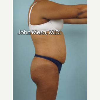 45-54 year old woman treated with Brazilian Butt Lift before 3777657