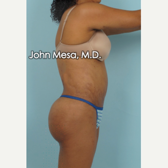 45-54 year old woman treated with Brazilian Butt Lift after 3777657