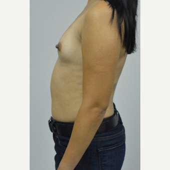35-44 year old woman treated with Breast Augmentation before 3005054