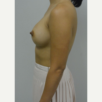 35-44 year old woman treated with Breast Augmentation after 3005054