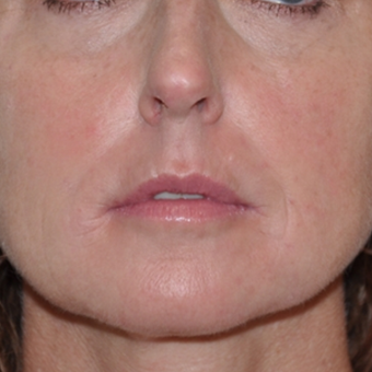 Non-surgical rejuvenation on 44 year old patient using Voluma, Juvederm XC, and Prevelle Silk after 2219128