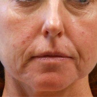 Non-surgical rejuvenation on 44 year old patient using Voluma, Juvederm XC, and Prevelle Silk before 2219128