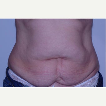 Mother treated with Tummy Tuck (abdominoplasty) before 2245928