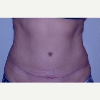 Mother treated with Tummy Tuck (abdominoplasty) after 2245928