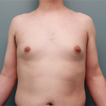 This 20 something year old man was treated with Liposuction to remove gynecomastia before 3467029